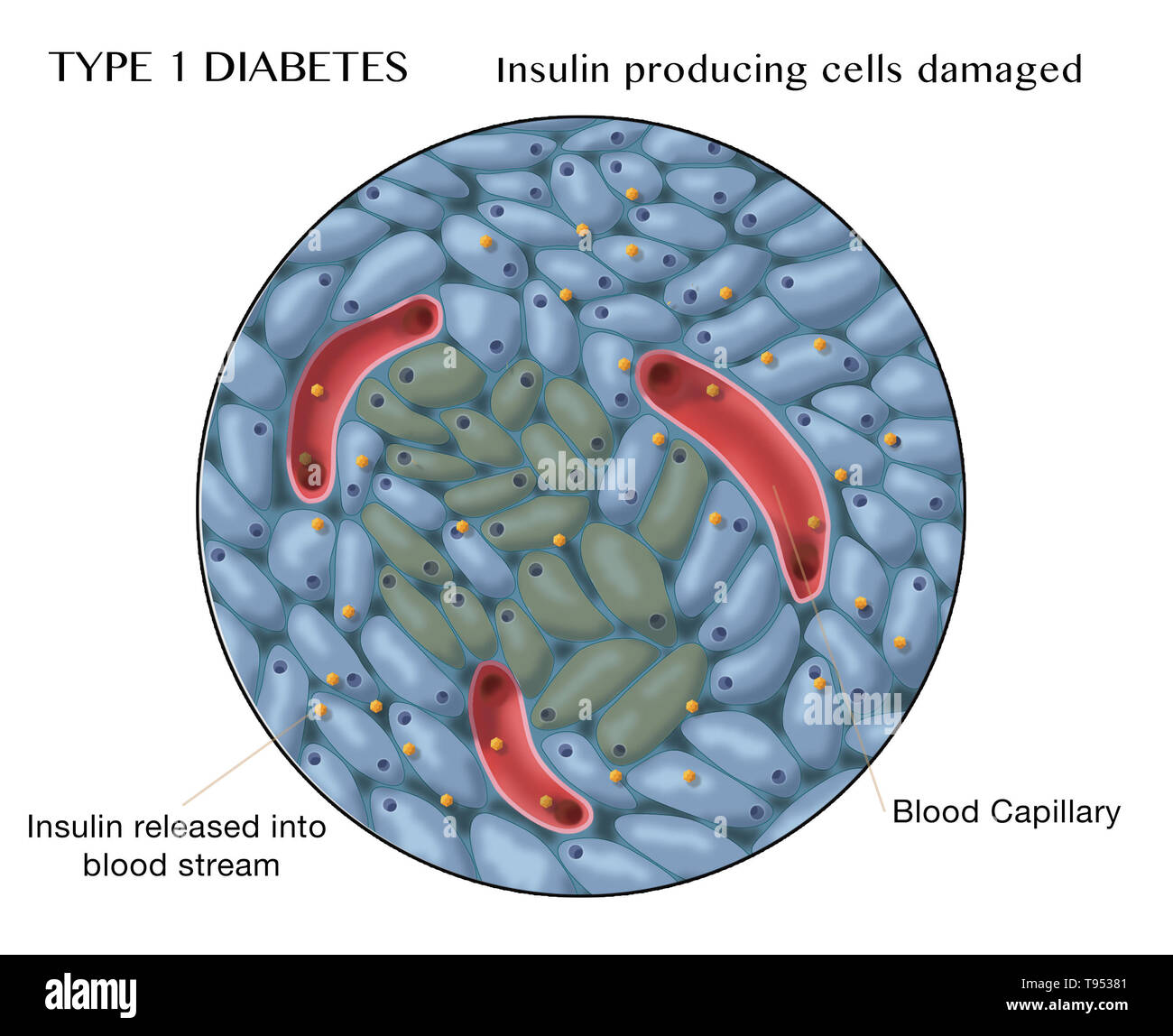Illustration of damaged islets of Langerhans in type 1 diabetes. Stock Photo