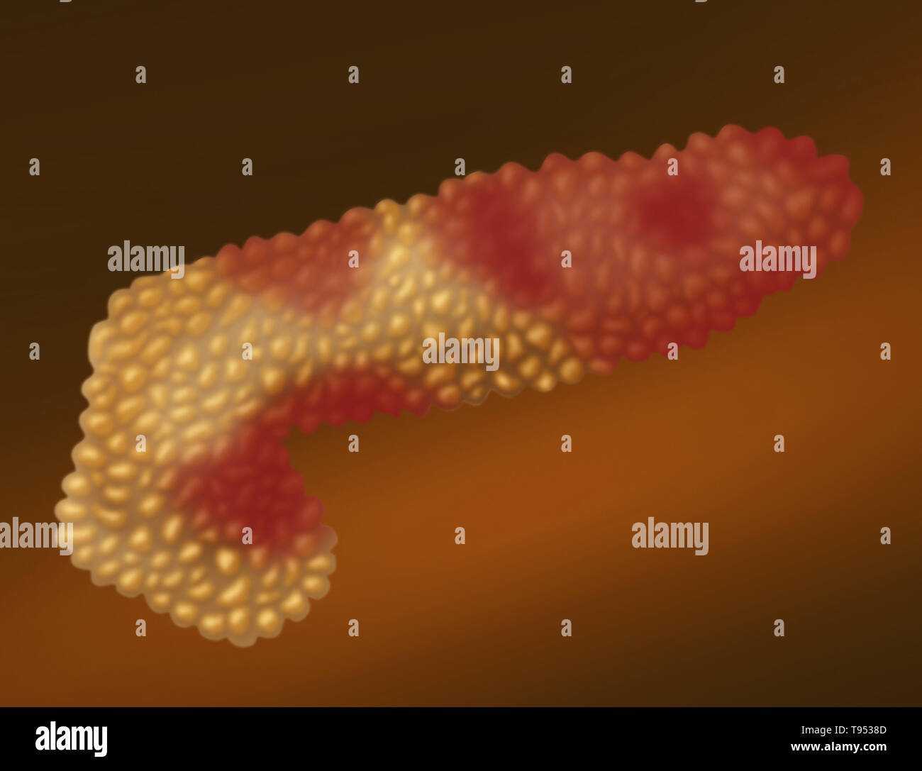 An illustration showing a pancreas with acute pancreatitis ...