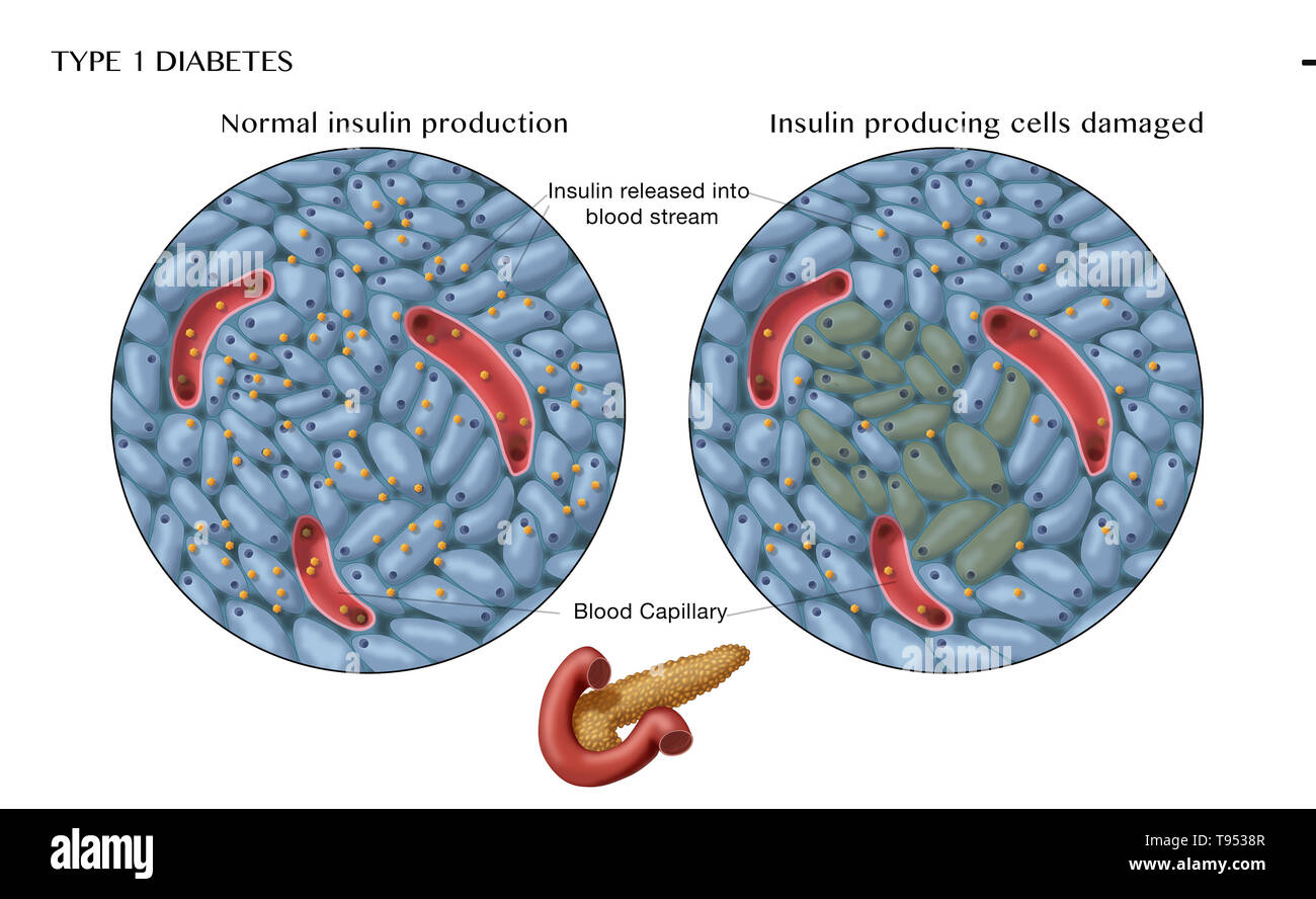 An illustration showing normal (left) and damaged insulin-producing cells (right) in type 1 diabetes. Stock Photo