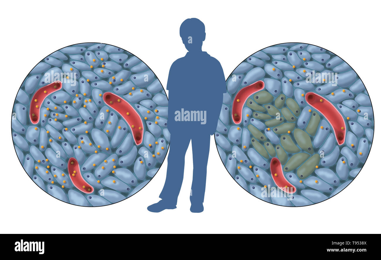 An illustration showing normal insulin production (left) and damaged