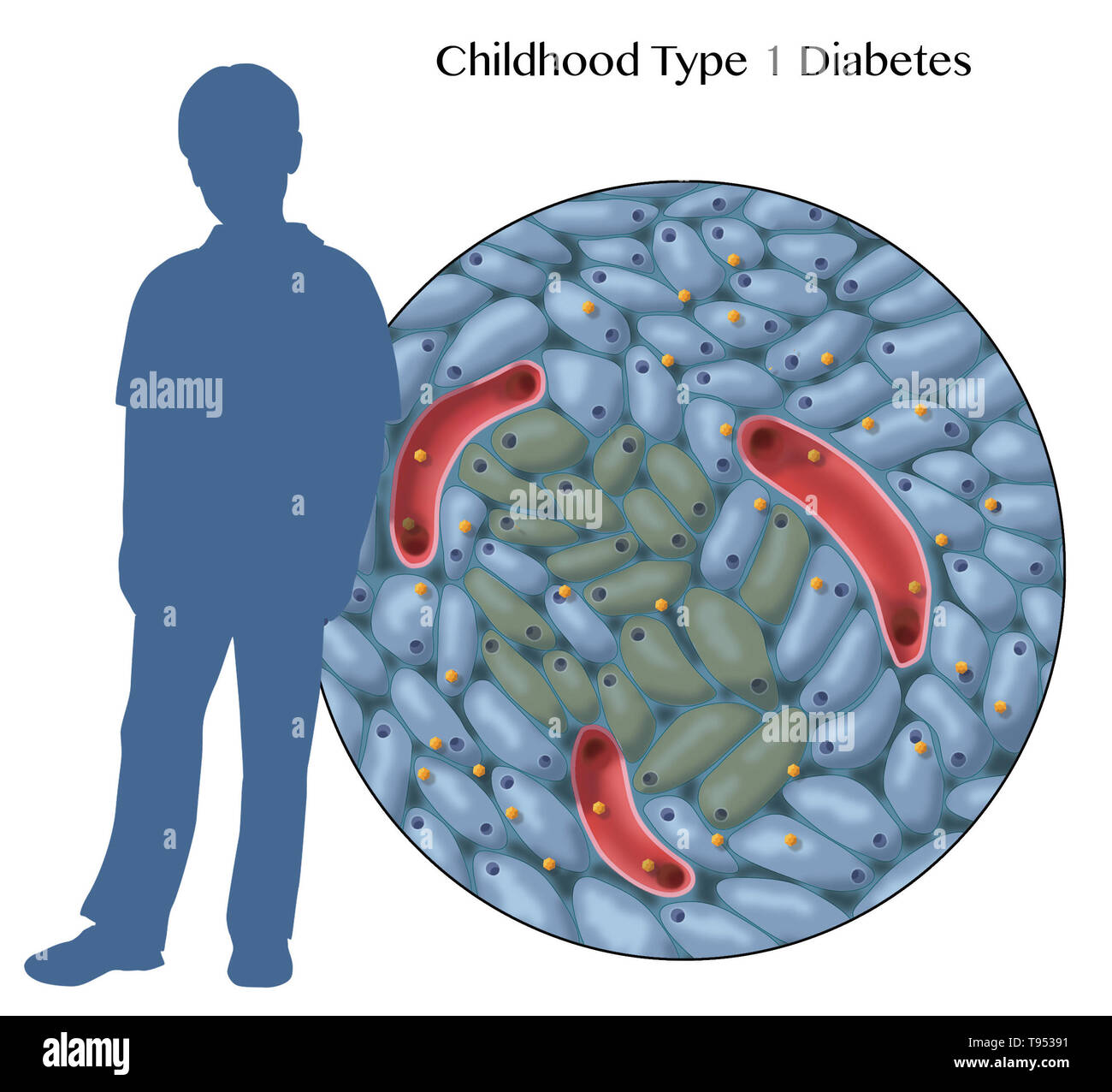 An illustration showing damaged insulin-producing cells in type 1 childhood diabetes. Stock Photo