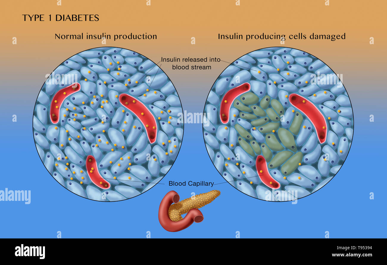 An illustration showing normal (left) and damaged insulin-producing cells (right) in type 1 diabetes. Stock Photo