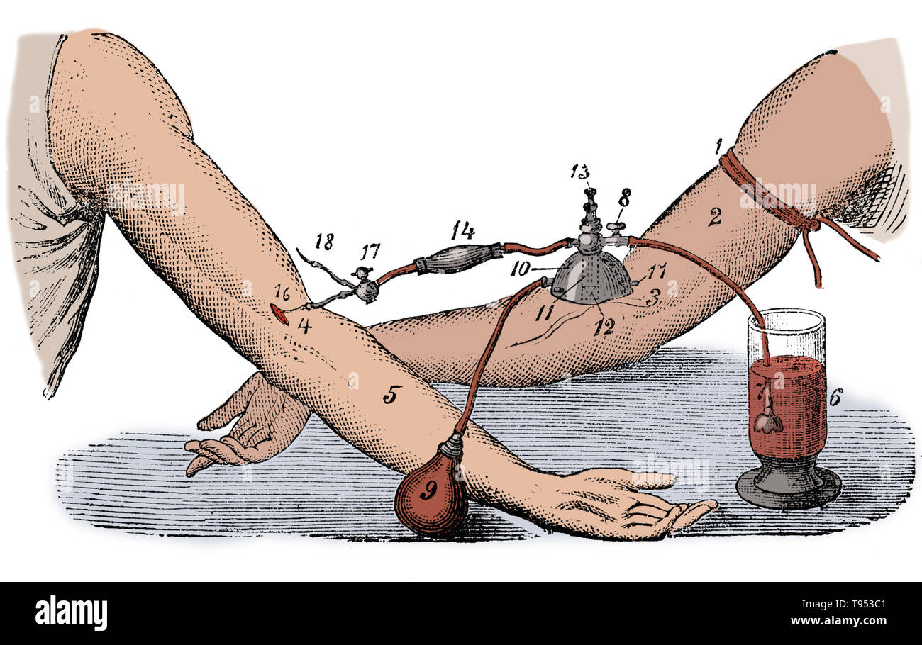 Blood transfusion between two people, J. Roussel, 1876. Beginning with Harvey's experiments with circulation of the blood, research into blood transfusion began in the 17th century, with successful experiments in transfusion between animals. However, successive attempts by physicians to transfuse animal blood into humans gave variable, often fatal, results. Early transfusions between humans were risky and many resulted in the death of the patient. It was not until 1901, when the Austrian Karl Landsteiner discovered human blood groups, that blood transfusions became safer. Stock Photo