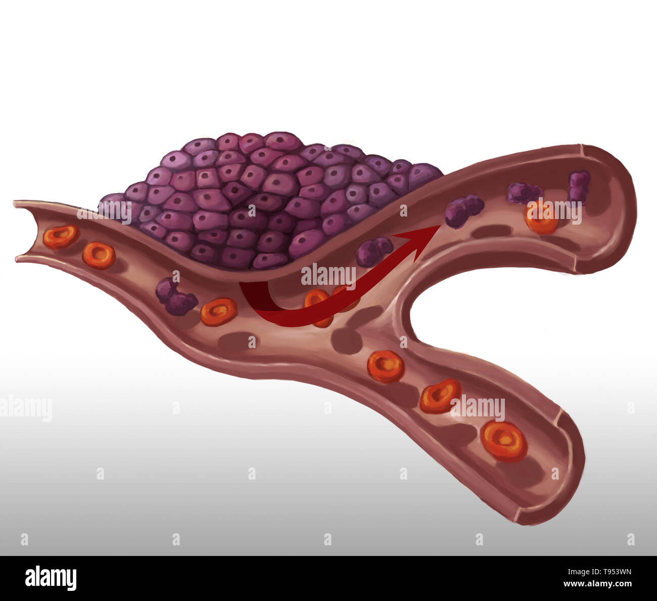 Illustration of tumor development. Stock Photo