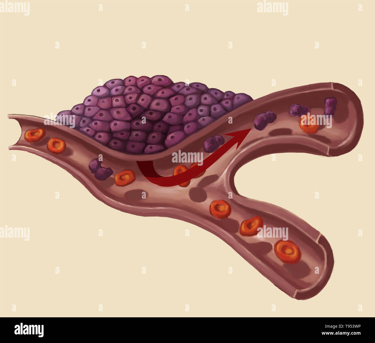 Illustration of tumor development. Stock Photo