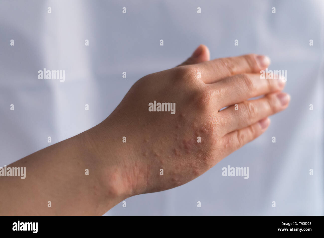 Herpes zoster hires stock photography and images Alamy