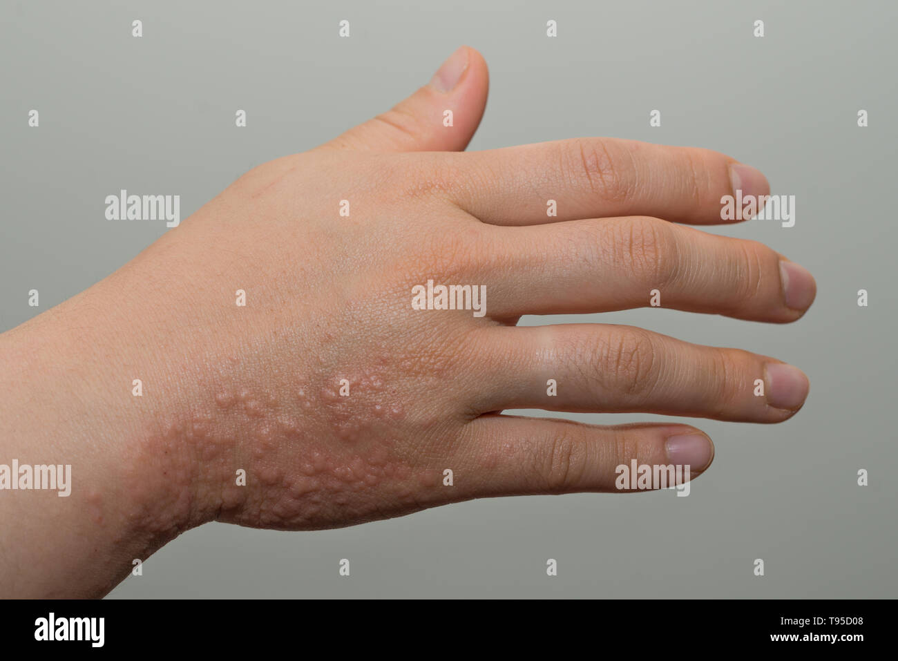 Herpes zoster rash hires stock photography and images Alamy