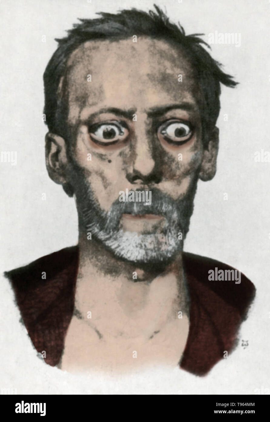 An historical illustration of a patient with Graves' ophthalmopathy (also known as Graves' Disease, Graves' thyroid-associated, or dysthyroid orbitopathy), an autoimmune inflammatory disorder affecting the orbit of the eye, with or without thyroid disorder. Stock Photo