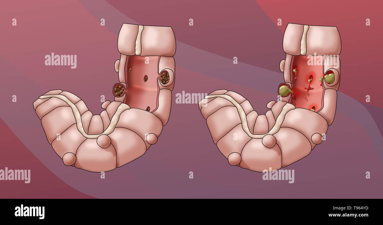 Illustration comparing the appearance of a colon with diverticulosis (left) with diverticulitis (right). Stock Photo