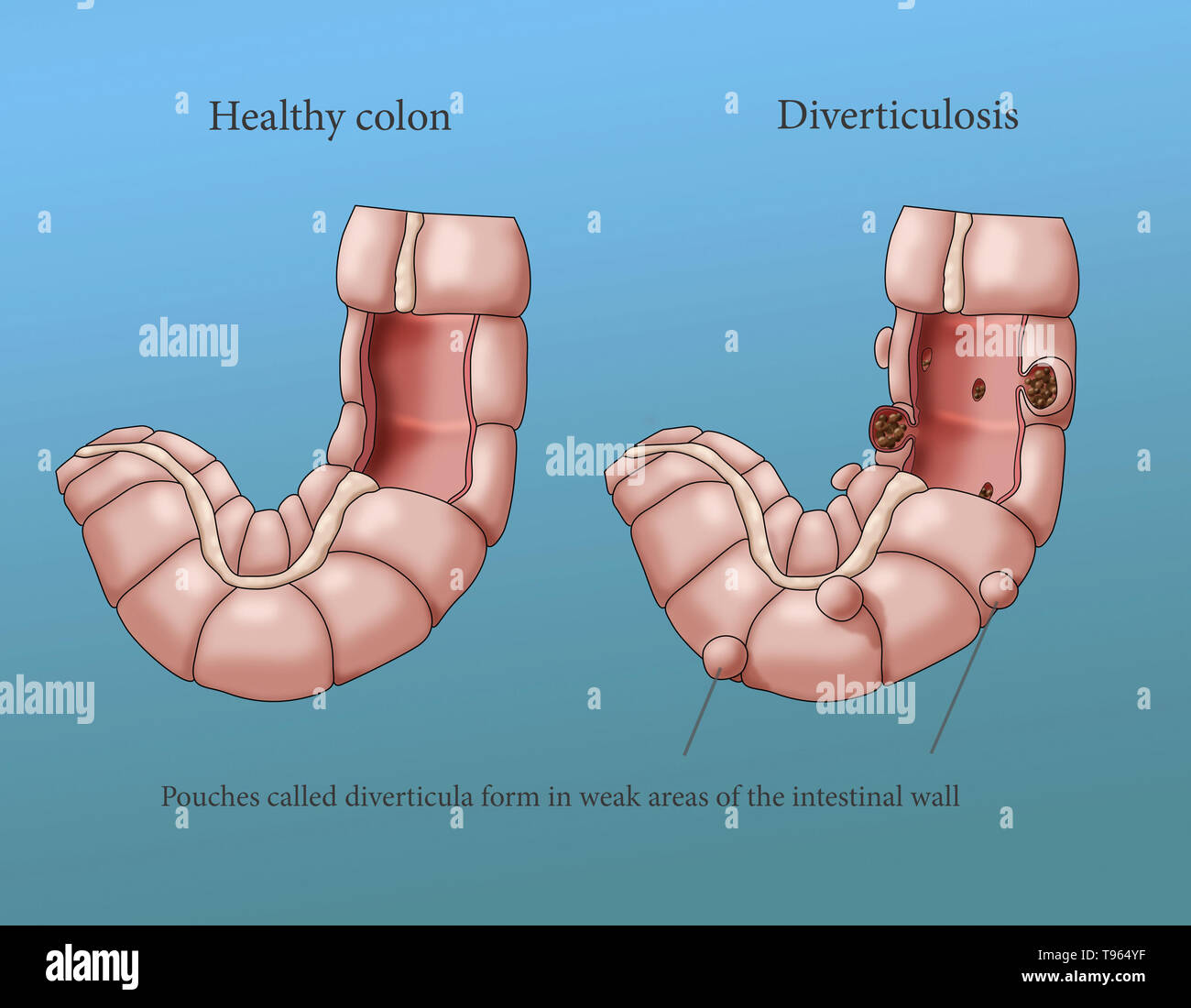 Illustration comparing the appearance of a healthy colon (left) to one with diverticulosis (right). Stock Photo