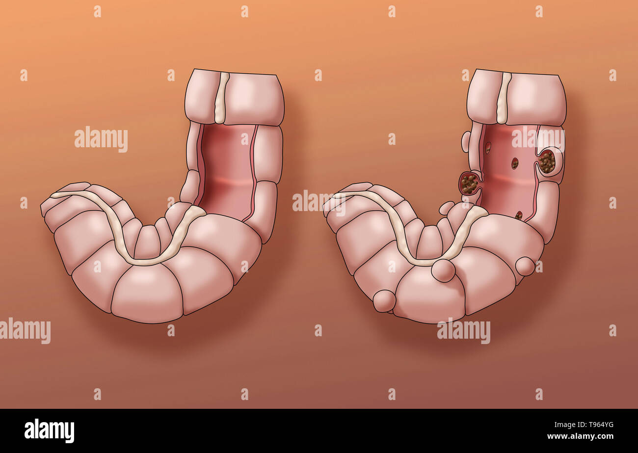 Illustration comparing the appearance of a healthy colon (left) to one with diverticulosis (right). Stock Photo