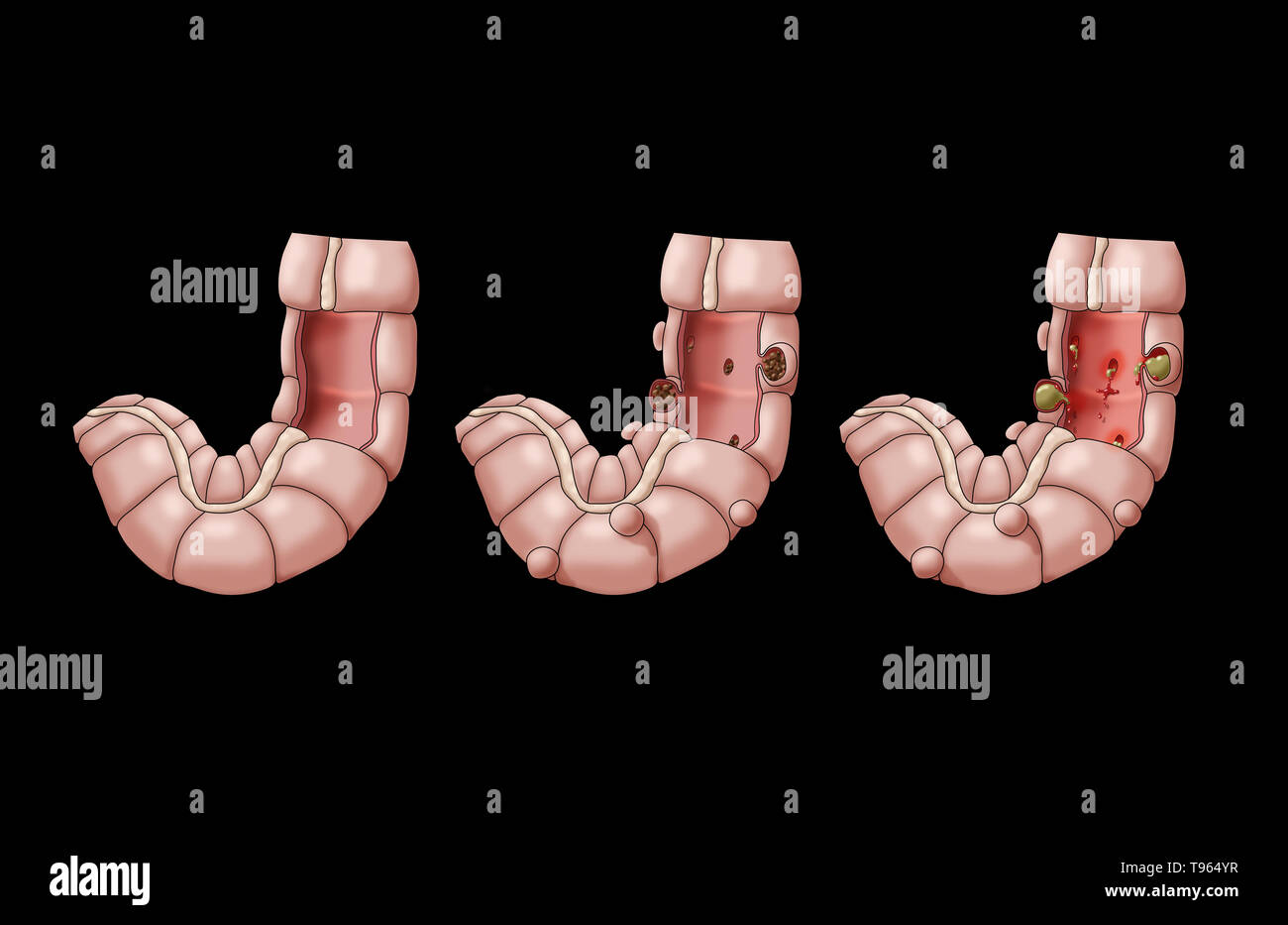 Illustration comparing the appearance of a healthy colon (left); diverticulosis (middle); and diverticulitis (right). Stock Photo