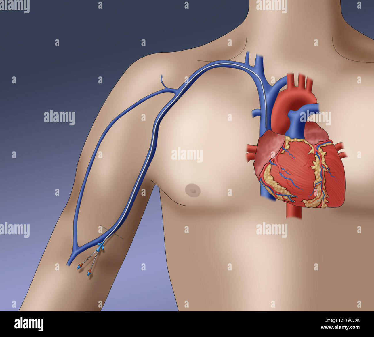 Illustration depicting a PICC (peripherally inserted central catheter), a form of intravenous access that can be used for a prolonged period of time (as in chemotherapy regimens, for example). Stock Photo