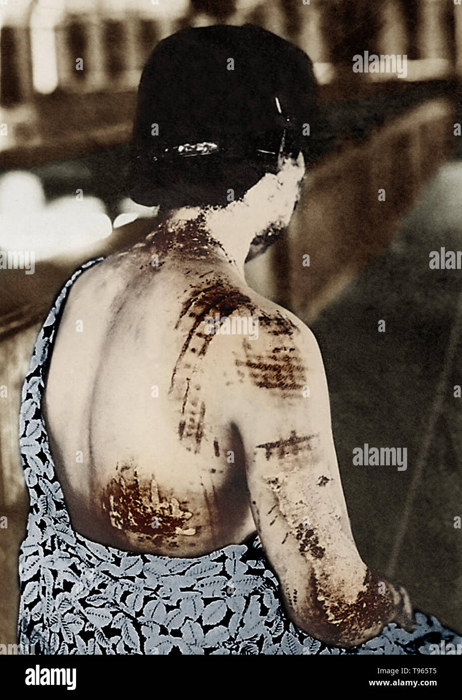 On August 6, 1945, near the end of World War II, the United States dropped an atomic bomb on the Japanese city of Hiroshima, destroying the city and killing over 70,000 people. In this image from a medical report of the bombing, the dark-colored pattern of a woman's clothes is shown to have absorbed thermal energy and burned the skin, particularly around more tight-fitting areas, such as the shoulders. Stock Photo