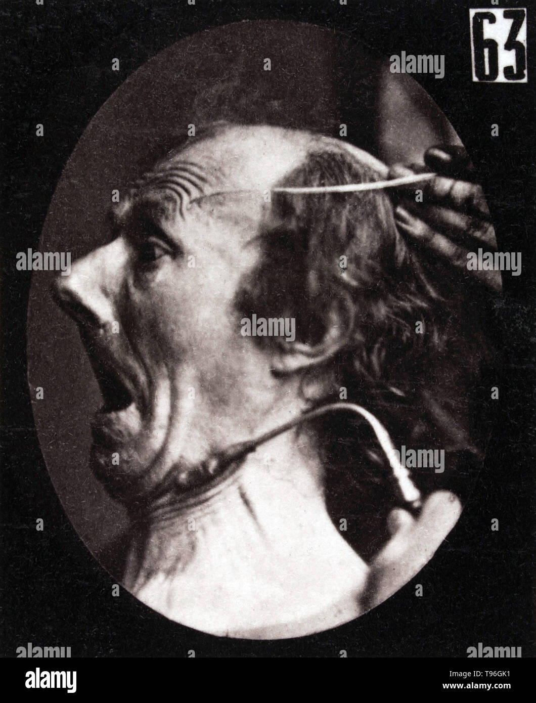 The facial expression of terror on the human face being induced by electrical currents. Guillaume-Benjamin-Amand Duchenne de Boulogne (September 17, 1806 - September 15, 1875) was a French neurologist who advanced the science of electrophysiology. Influenced by the beliefs of physiognomy, Duchenne wanted to determine how the muscles in the human face produce facial expressions which he believed to be directly linked to the soul of man. Stock Photo