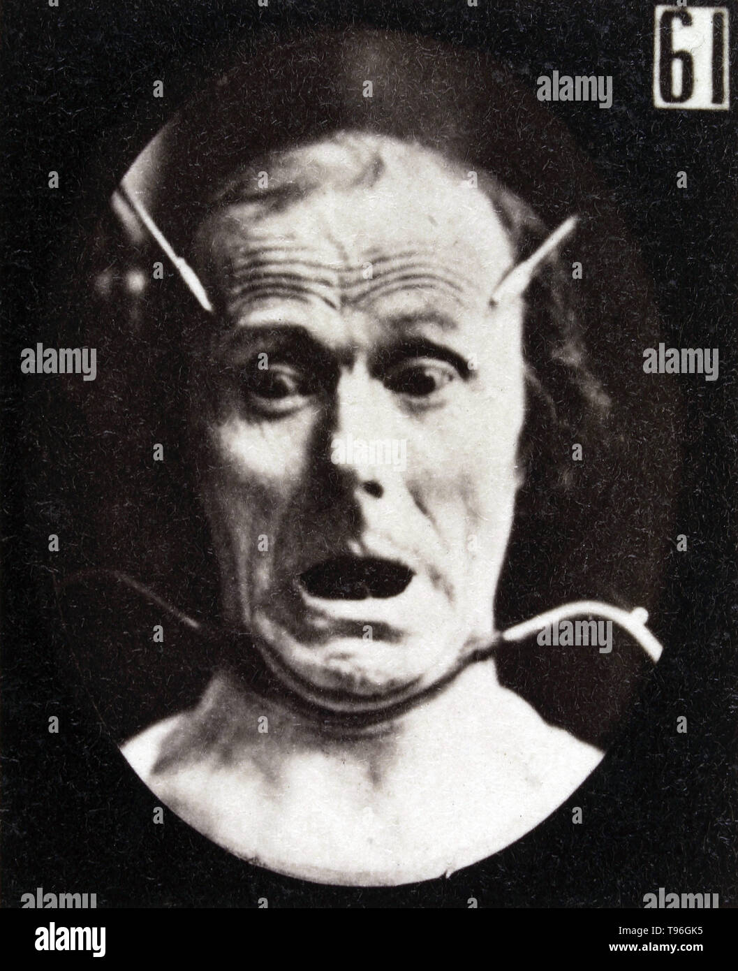 The facial expression of fear on the human face being induced by electrical currents. Guillaume-Benjamin-Amand Duchenne de Boulogne (September 17, 1806 - September 15, 1875) was a French neurologist who advanced the science of electrophysiology. Influenced by the beliefs of physiognomy, Duchenne wanted to determine how the muscles in the human face produce facial expressions which he believed to be directly linked to the soul of man. Stock Photo