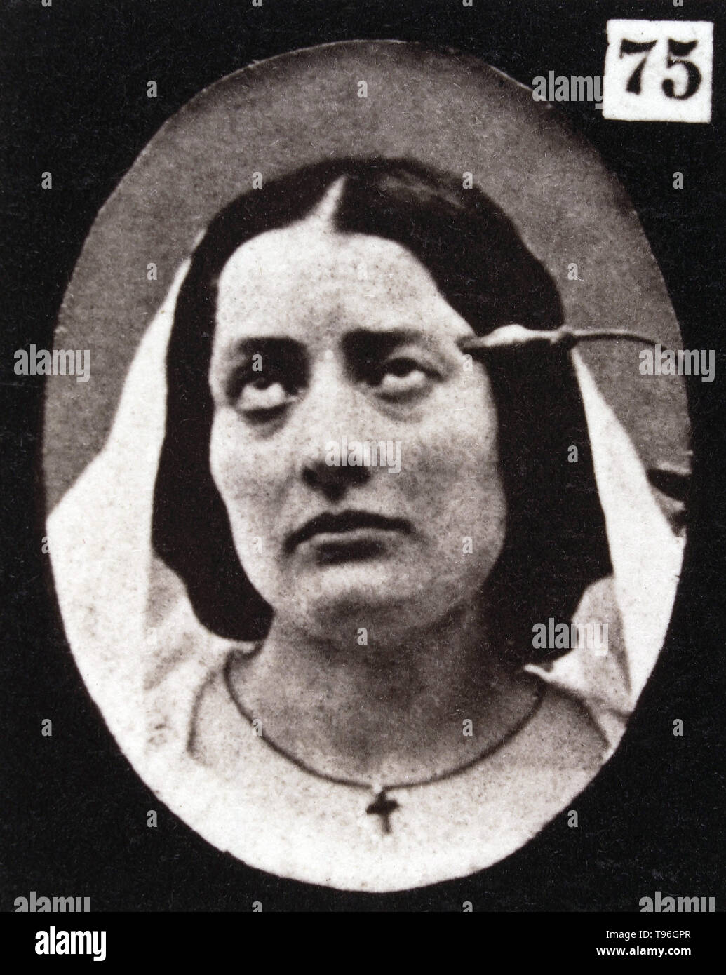 The facial expression of pain on the human face being induced by electrical currents. Guillaume-Benjamin-Amand Duchenne de Boulogne (September 17, 1806 - September 15, 1875) was a French neurologist who advanced the science of electrophysiology. Influenced by the beliefs of physiognomy, Duchenne wanted to determine how the muscles in the human face produce facial expressions which he believed to be directly linked to the soul of man. Stock Photo