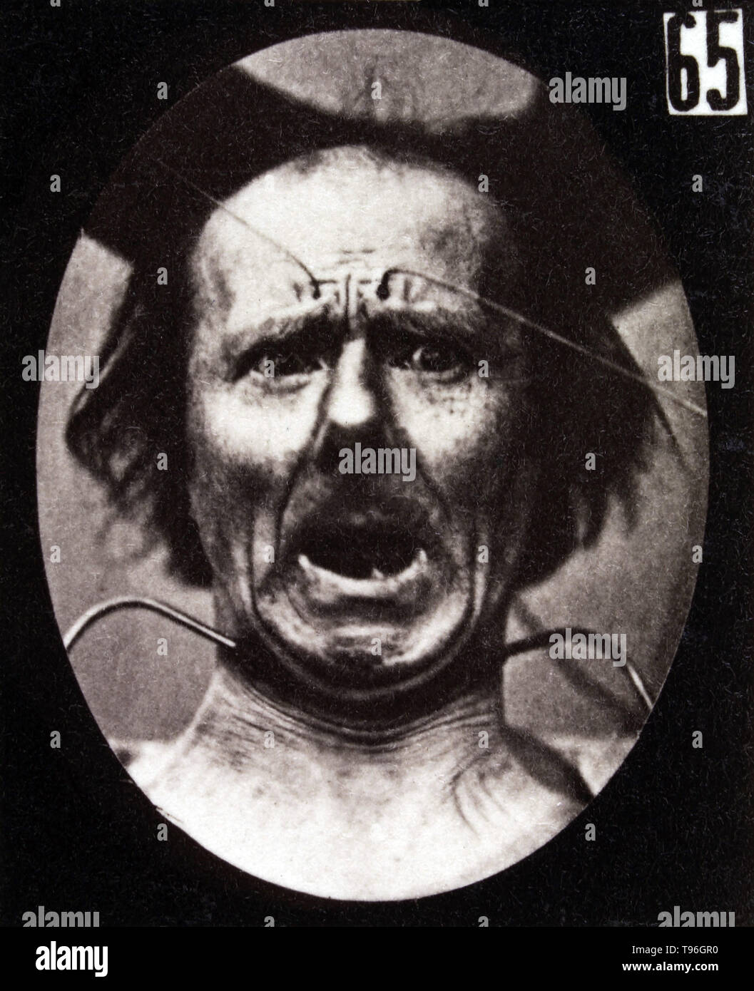 The facial expression of fear on the human face being induced by electrical currents. Guillaume-Benjamin-Amand Duchenne de Boulogne (September 17, 1806 - September 15, 1875) was a French neurologist who advanced the science of electrophysiology. Influenced by the beliefs of physiognomy, Duchenne wanted to determine how the muscles in the human face produce facial expressions which he believed to be directly linked to the soul of man. Stock Photo
