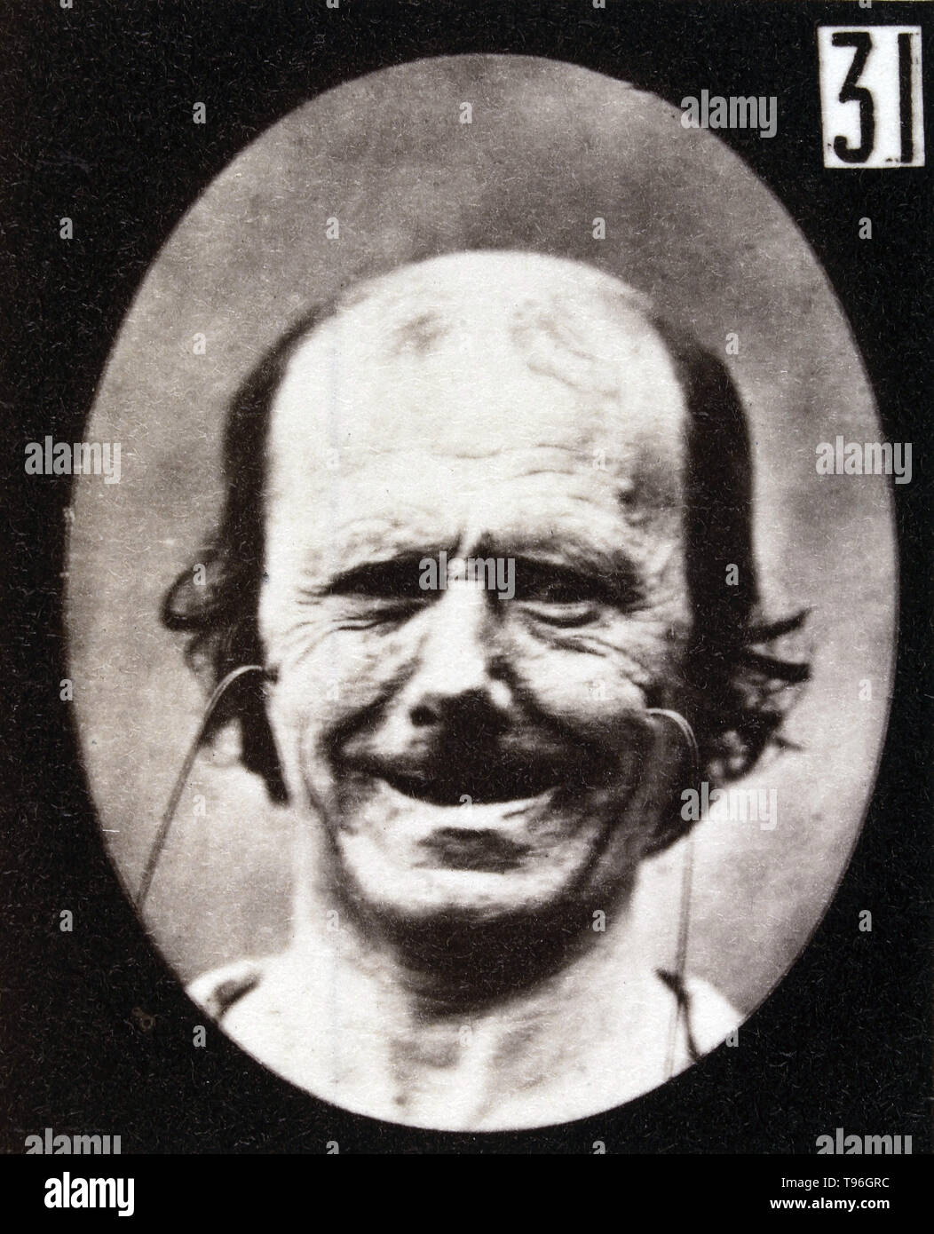 The facial expression of false laughter on the human face being induced by electrical currents. Guillaume-Benjamin-Amand Duchenne de Boulogne (September 17, 1806 - September 15, 1875) was a French neurologist who advanced the science of electrophysiology. Influenced by the beliefs of physiognomy, Duchenne wanted to determine how the muscles in the human face produce facial expressions which he believed to be directly linked to the soul of man. Stock Photo