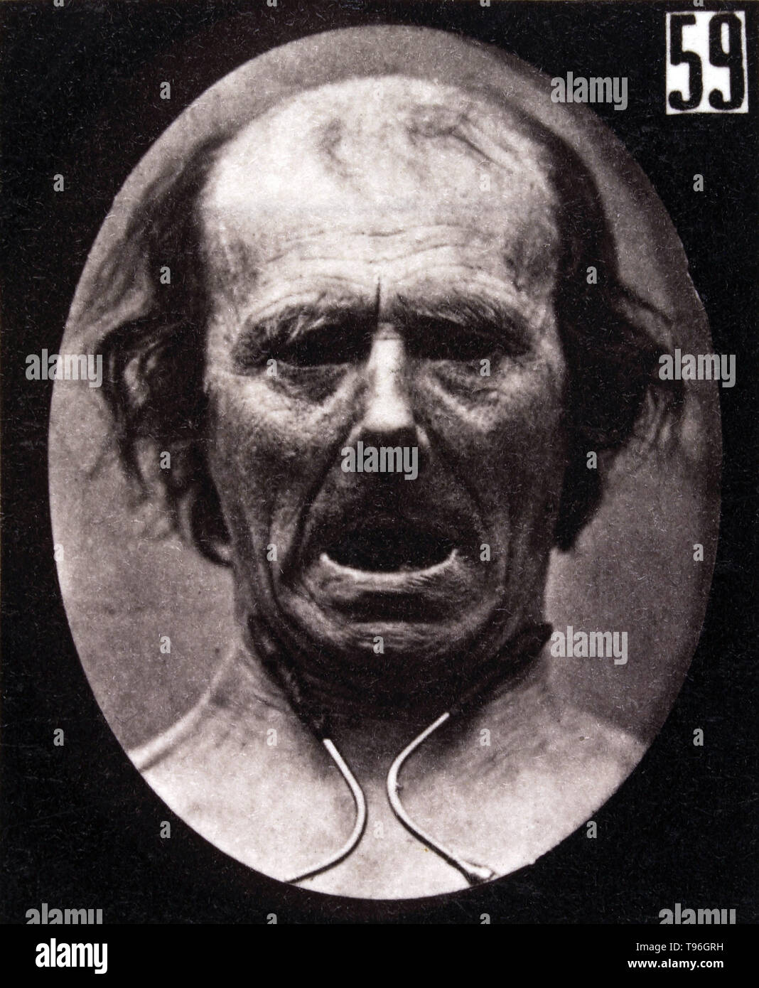 Facial contraction lacking in expression, induced by electrical currents. Guillaume-Benjamin-Amand Duchenne de Boulogne (September 17, 1806 - September 15, 1875) was a French neurologist who advanced the science of electrophysiology. Influenced by the beliefs of physiognomy, Duchenne wanted to determine how the muscles in the human face produce facial expressions which he believed to be directly linked to the soul of man. Stock Photo