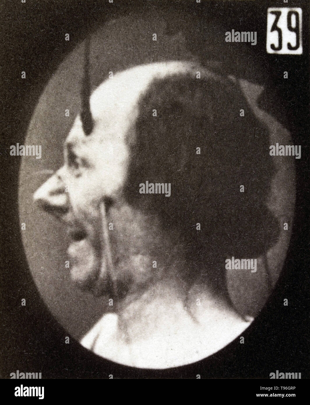 The facial expression of desire on the human face being induced by electrical currents. Guillaume-Benjamin-Amand Duchenne de Boulogne (September 17, 1806 - September 15, 1875) was a French neurologist who advanced the science of electrophysiology. Influenced by the beliefs of physiognomy, Duchenne wanted to determine how the muscles in the human face produce facial expressions which he believed to be directly linked to the soul of man. Stock Photo