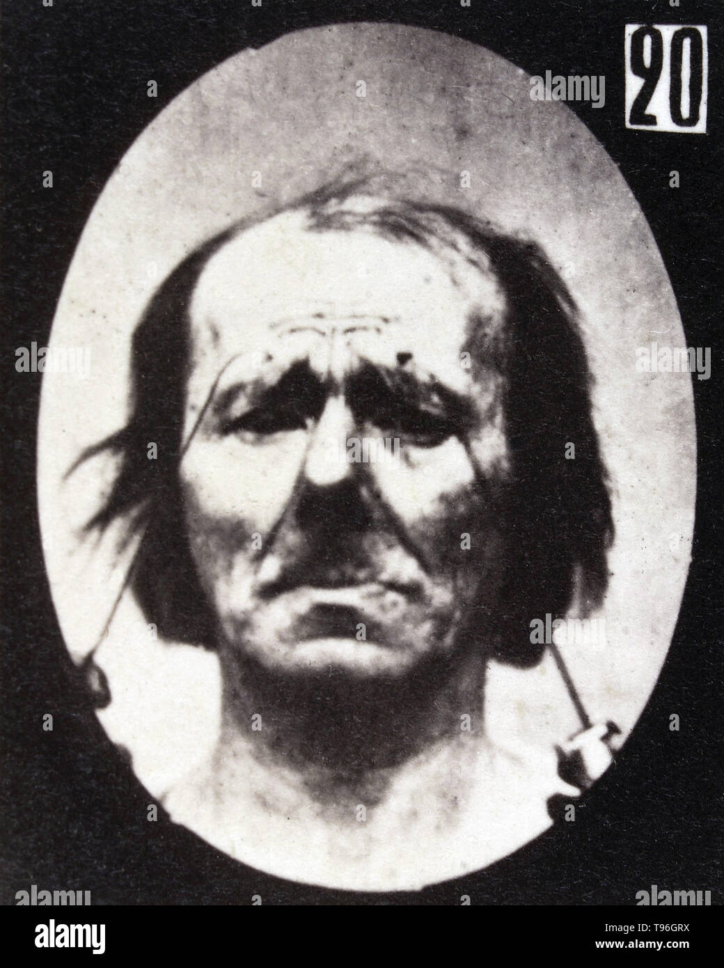 The facial expression of profound suffering on the human face being induced by electrical currents. Guillaume-Benjamin-Amand Duchenne de Boulogne (September 17, 1806 - September 15, 1875) was a French neurologist who advanced the science of electrophysiology. Influenced by the beliefs of physiognomy, Duchenne wanted to determine how the muscles in the human face produce facial expressions which he believed to be directly linked to the soul of man. Stock Photo