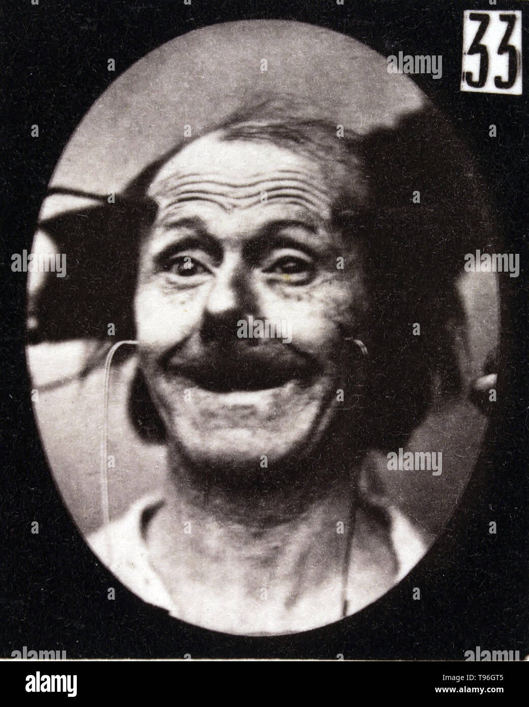 The facial expression of surprise on the human face being induced by electrical currents. Guillaume-Benjamin-Amand Duchenne de Boulogne (September 17, 1806 - September 15, 1875) was a French neurologist who advanced the science of electrophysiology. Influenced by the beliefs of physiognomy, Duchenne wanted to determine how the muscles in the human face produce facial expressions which he believed to be directly linked to the soul of man. Stock Photo