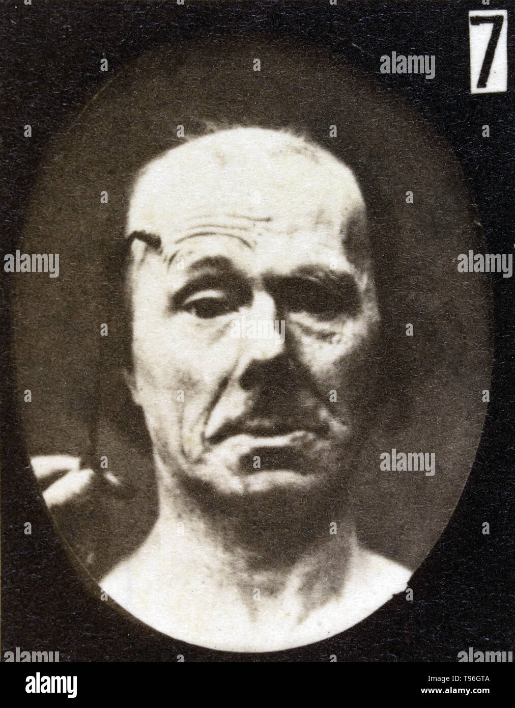 The facial expression of attention on the human face being induced by electrical currents. Guillaume-Benjamin-Amand Duchenne de Boulogne (September 17, 1806 - September 15, 1875) was a French neurologist who advanced the science of electrophysiology. Influenced by the beliefs of physiognomy, Duchenne wanted to determine how the muscles in the human face produce facial expressions which he believed to be directly linked to the soul of man. Stock Photo