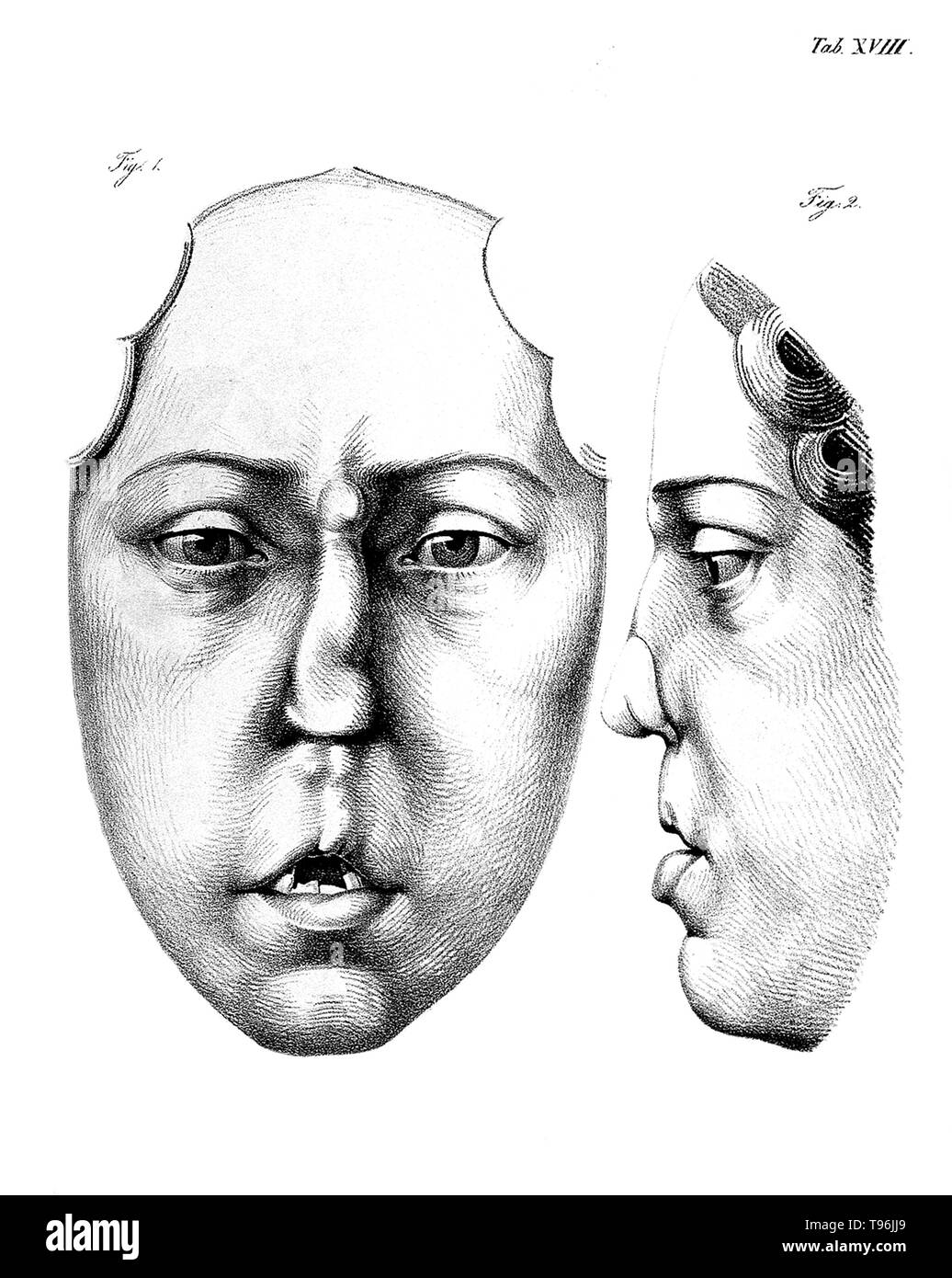 Chirurgische Erfahrungen. Front view and side view of woman paying particular attention to the nose. Johann Friedrich Dieffenbach (February  1, 1792 -  November 11, 1847) was a German surgeon who specialized in skin transplantation and plastic surgery. His work in rhinoplastic and maxillofacial surgery established many modern techniques of reconstructive surgery. Before the discovery of blood typing and blood matching, Dieffenbach researched blood transfusion. Stock Photo