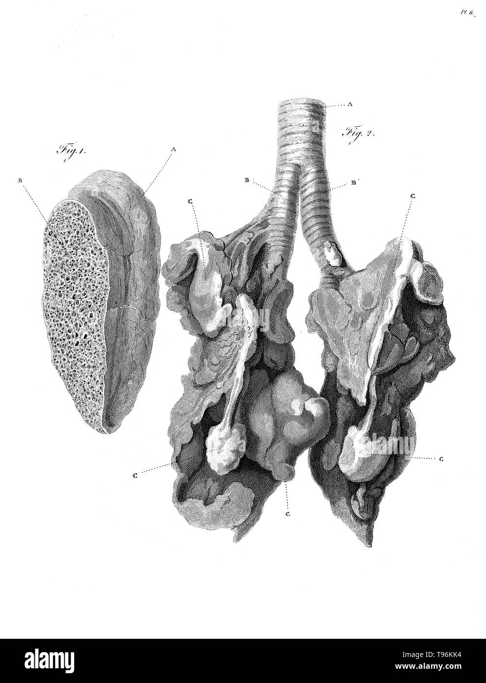 Section of lung of Samuel Johnson. Postmortem examination showed that Johnson had suffered from emphysema of the lungs. Samuel Johnson (September 18, 1709 - December 13, 1784), often referred to as Dr. Johnson, was an English author who made lasting contributions to English literature as a poet, essayist, moralist, literary critic, biographer, editor and lexicographer. Johnson was a devout Anglican and committed Tory. He is the subject of James Boswell's Life of Samuel Johnson. Stock Photo