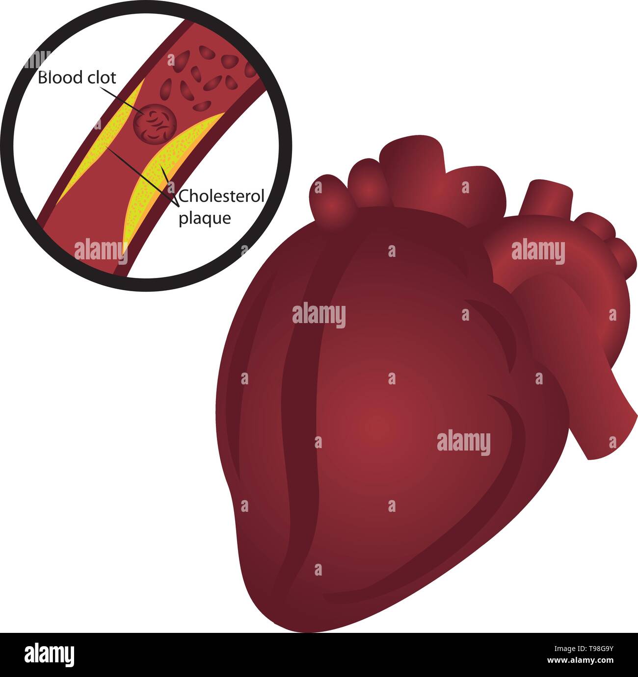 Blood clot  cholesterol plaque in artery Heart attack vector illustration Stock Vector