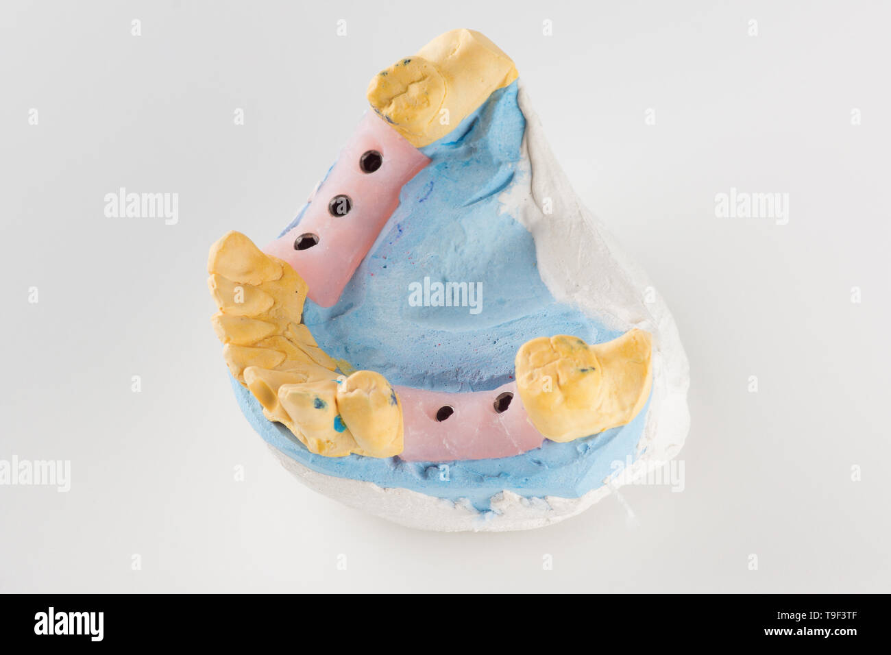 dental plaster model with artificial analogues of dental implants Stock