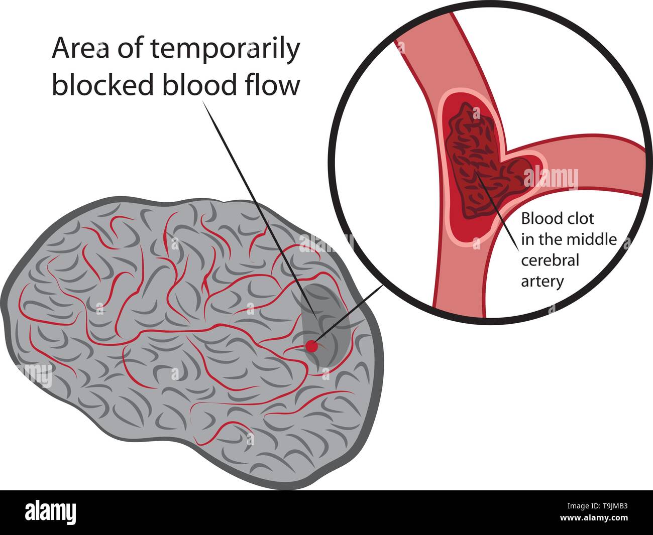 Stroke develope in human brains vecroe illustration Stock Vector
