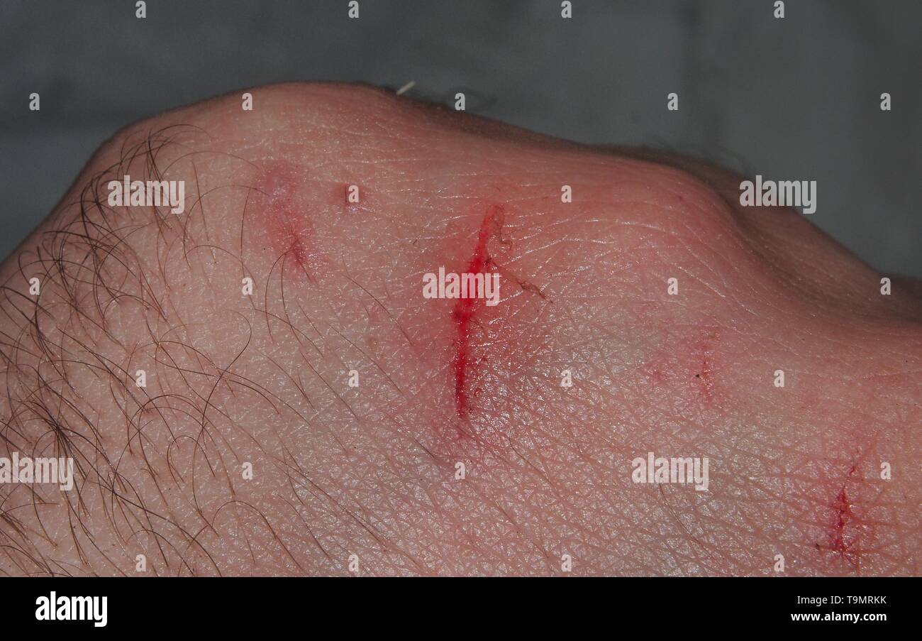 A bleeding scratch on the back of his hand. Small injury. Skin damage. Stock Photo