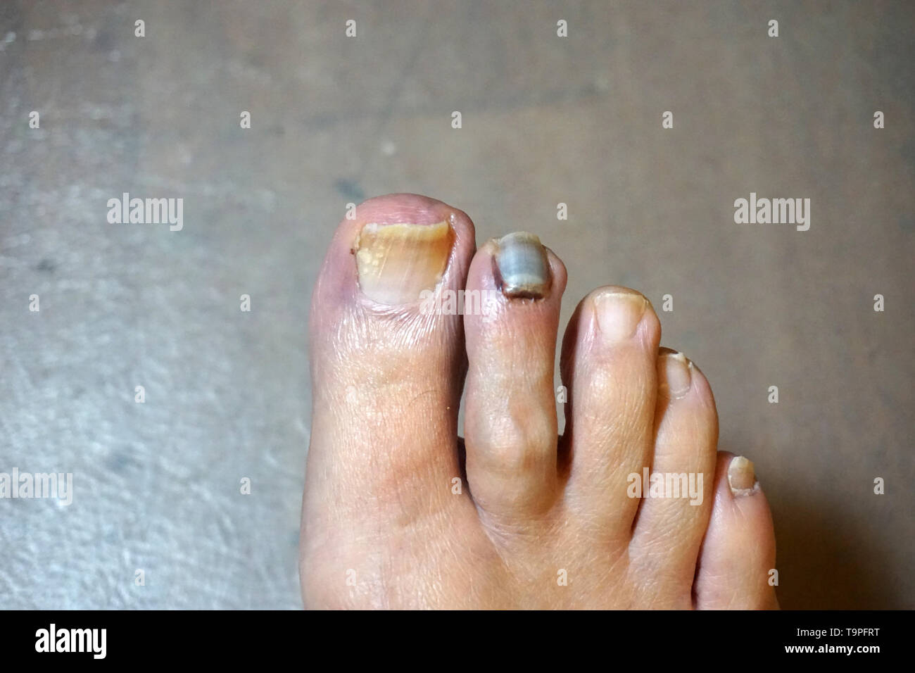 Smashed toe hi-res stock photography and images - Alamy Smashed toe hi-res stock photography and images - Alamy