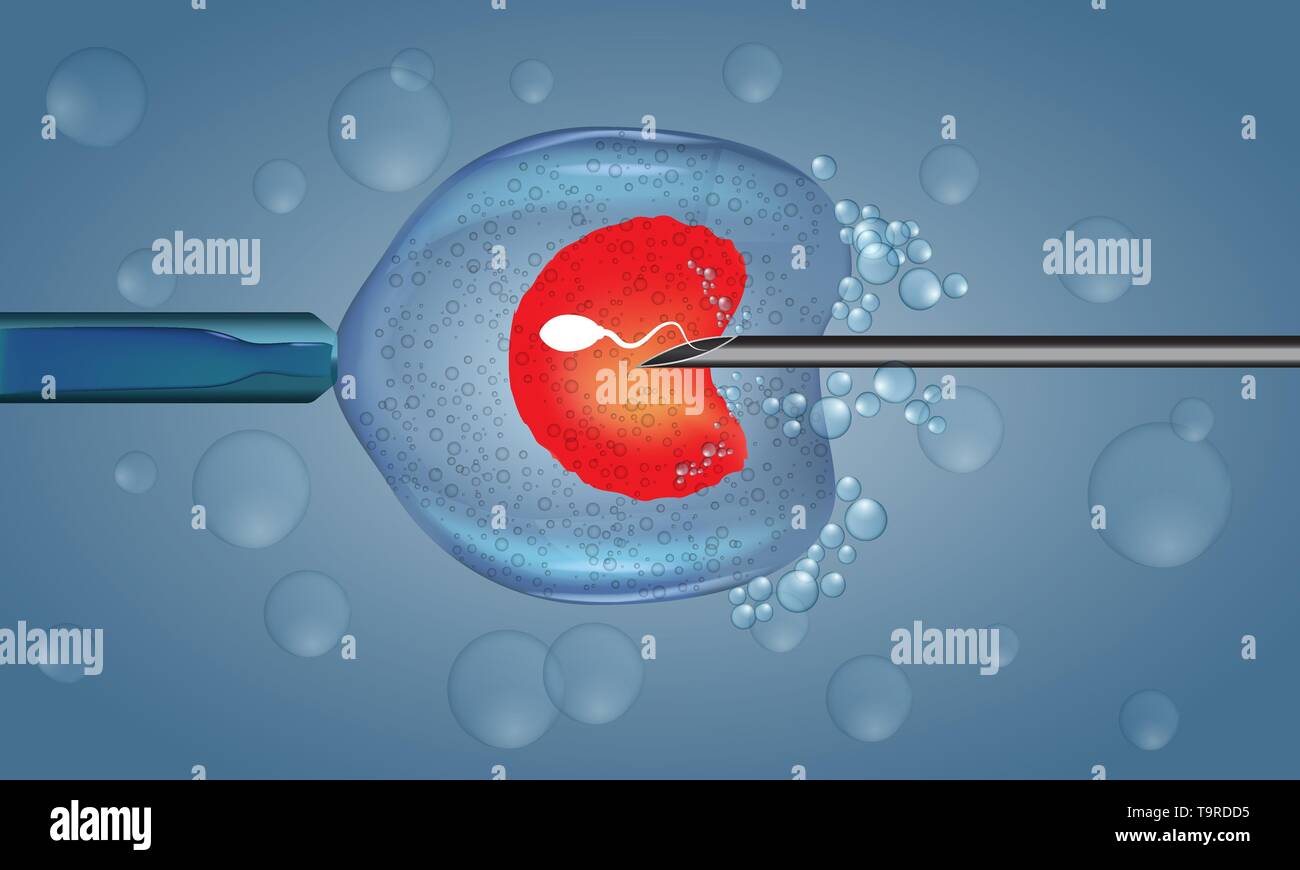 Икси и эко в чем отличие. Икси и эко в чем отличие. Икси метод оплодотворения. Эко экстракорпоральное оплодотворение. Икси и эко в чем отличие.