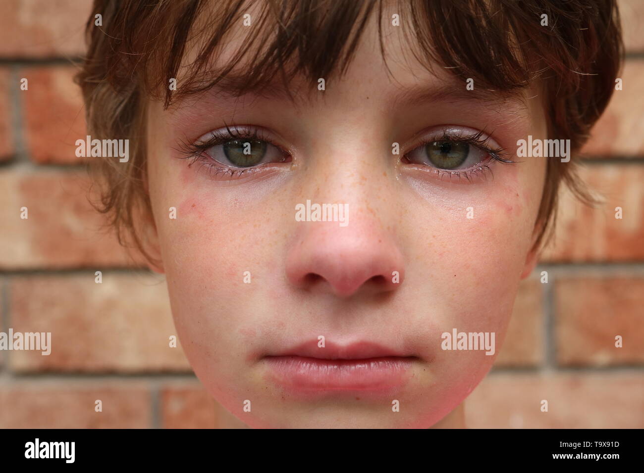 Portrait of an upset child with red blotchy skin and big green eyes Stock Photo