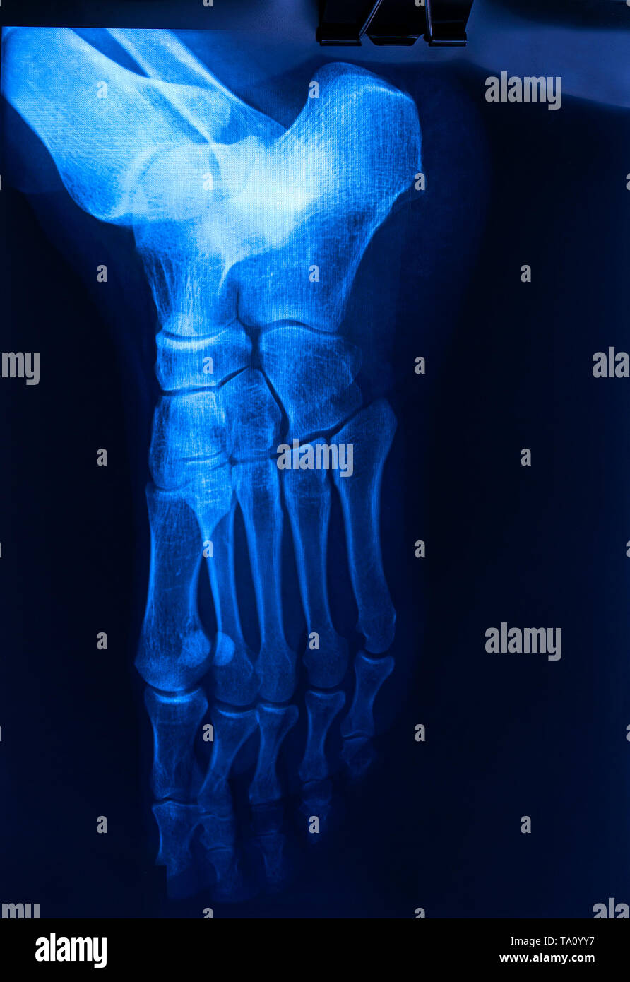 Xray human's ankle with arthritis , top view Stock Photo Alamy