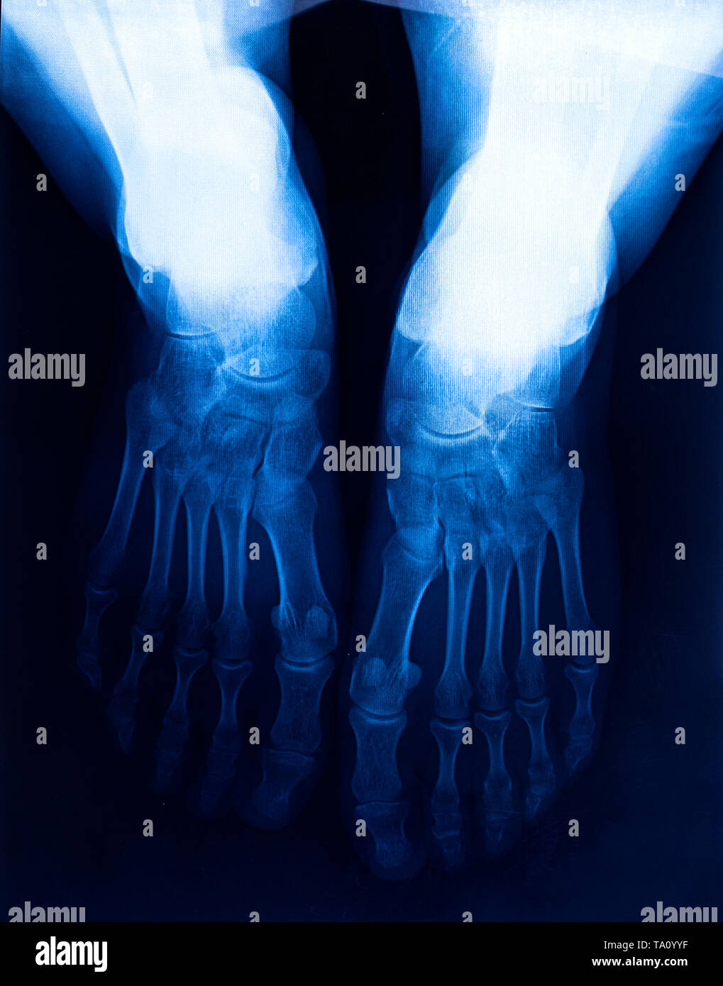 Xray human's ankle with arthritis , top view Stock Photo Alamy