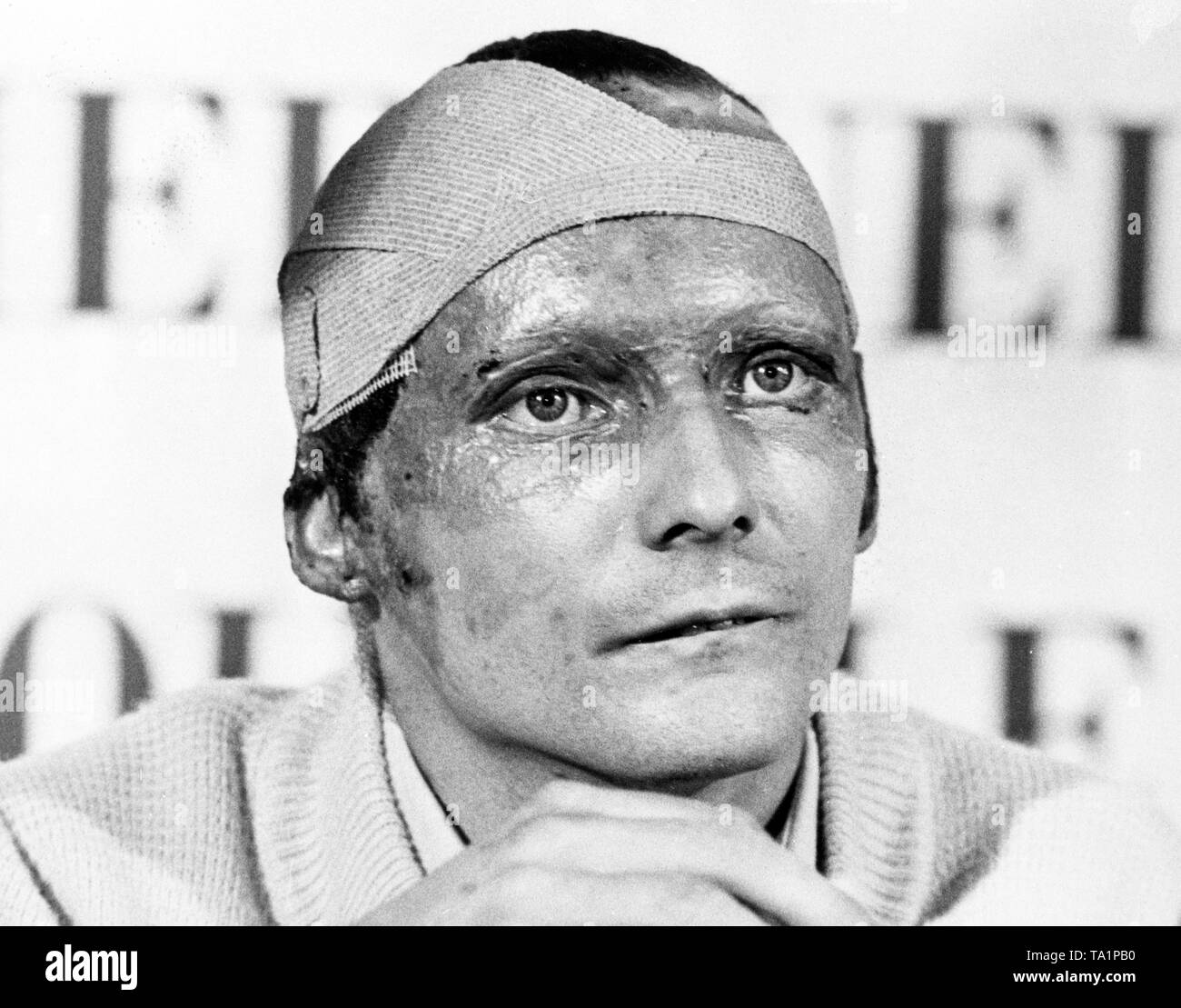 Austrian driver, Niki Lauda, after his skin grafting operation following  his crash in the 1976 German Grand Prix at the Nurburgring. *UK USE ONLY  Stock Photo - Alamy