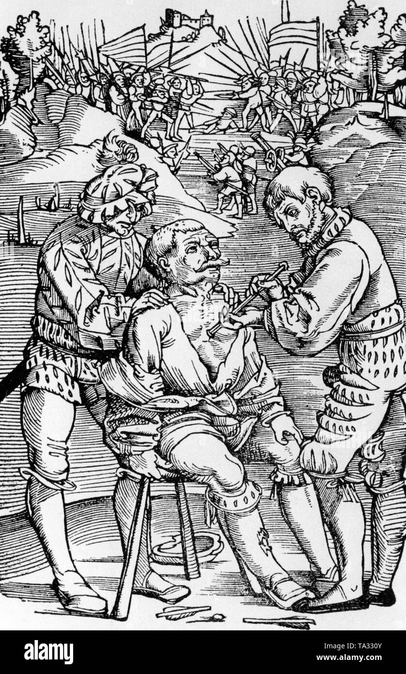 Illustration of a doctor treating a wounded Landsknecht. The illustration is  from the 'Feldbuch der Wundarznei' (Fieldbook of Surgery) by Hans von Gersdorff. The book was printed in Strasbourg. Stock Photo