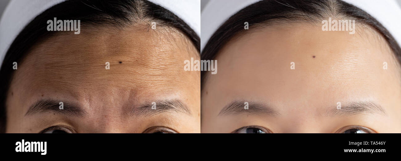 forehead wrinkles problem. pictures compared effect Before and After treatment for forehead wrinkles skin problem in woman to solve skin problem for b Stock Photo