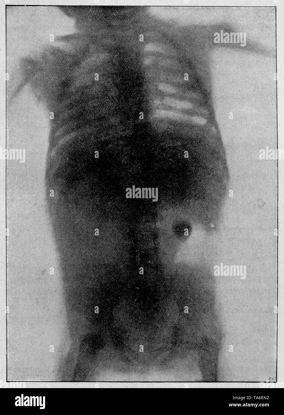 X-ray of the chest of a child who swallowed a coin. X-ray by W.A. Hirschmann, Berlin ,  (Health book, 1911) Stock Photo