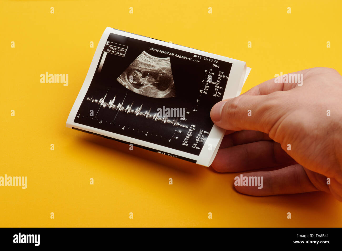 Ultrasound scan with future baby parameters in hand on yellow background Stock Photo