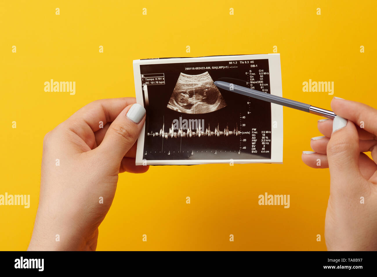 Browsing ultrasound photo. Checking scan of pregnant woman Stock Photo