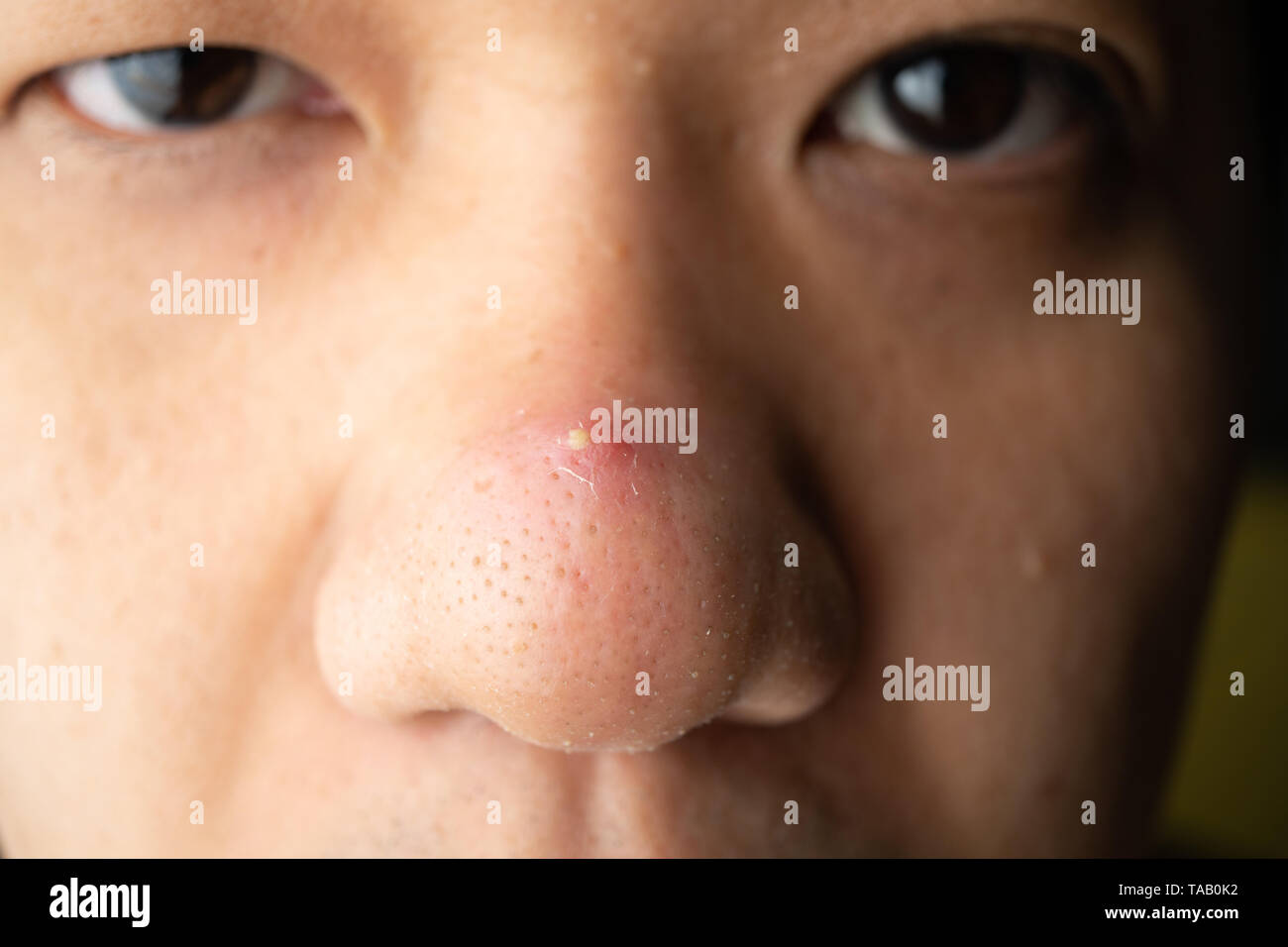 Closedup many blackhead pimples and acne scars on the nose of an Asian