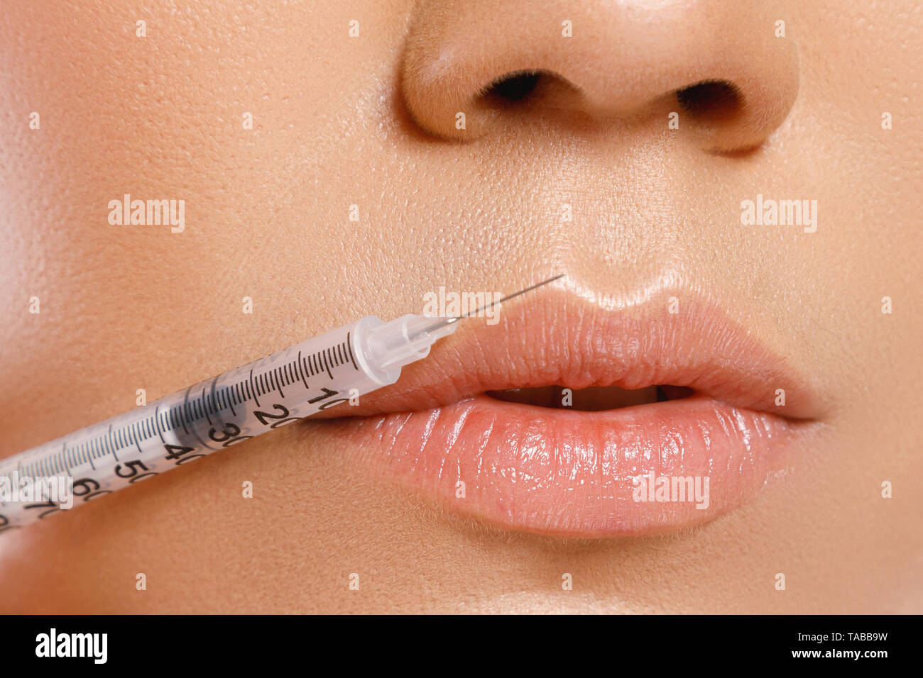 Female lips and syringe with a filler. Lip augmentation procedure Stock