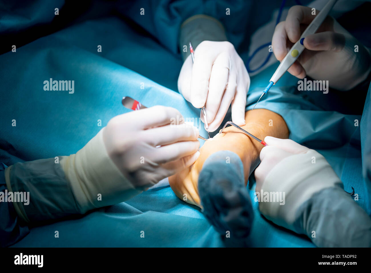 Doctors performing an ankle operation in hospital Stock Photo