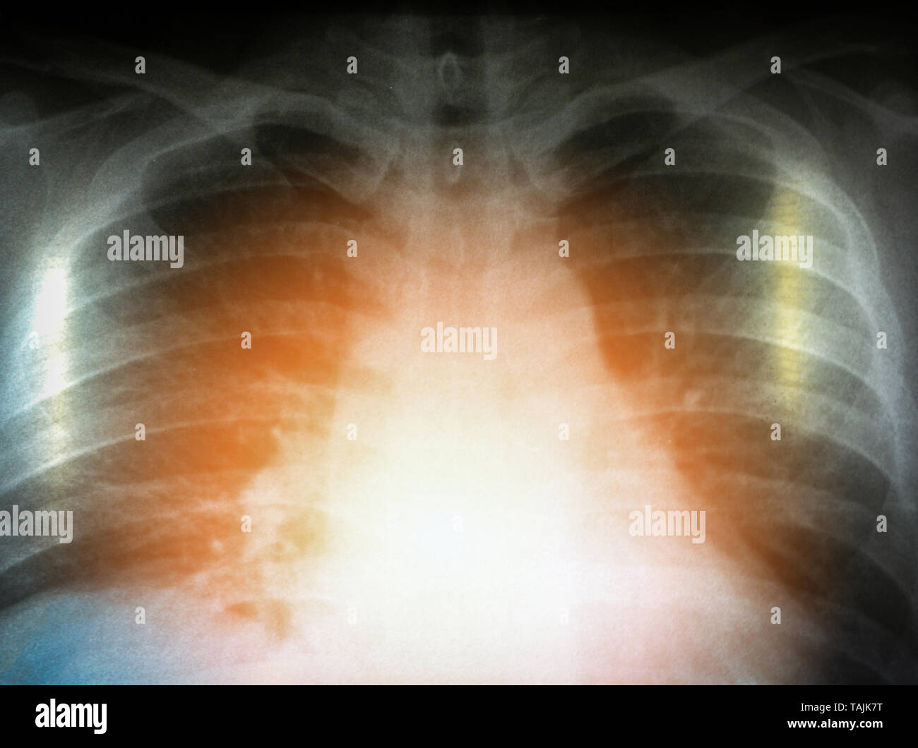 Pulmonary tuberculosis film chest x ray hi-res stock photography and ...