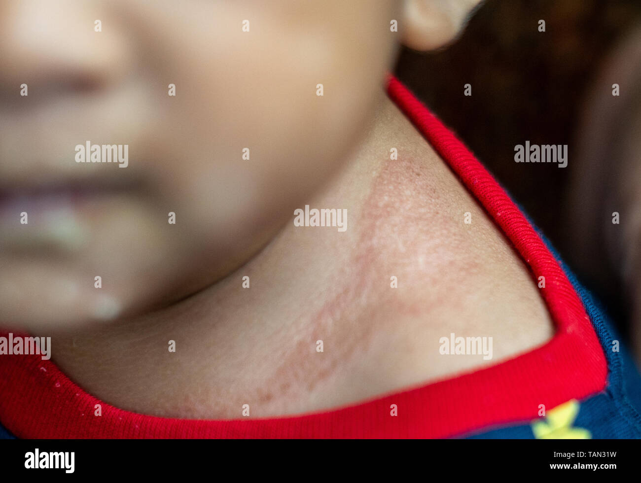 Eczema can show up as red, crusty patches on your baby's skin, often during their first few months. It’s common and very treatable. Many infants outgr Stock Photo